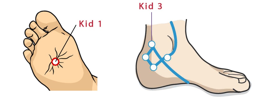 Kidney-Point